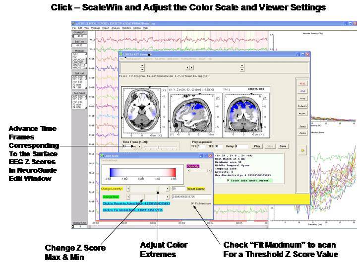 LORETA Current Density Normative Database – Applied Neuroscience, Inc.