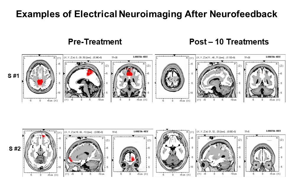 Two Examples of Electrical NeuroImaging After 10 Surface EEG Neurofeedback Treatments