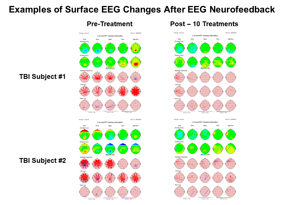 Examples of Surface EEG Changes After EEG NFB